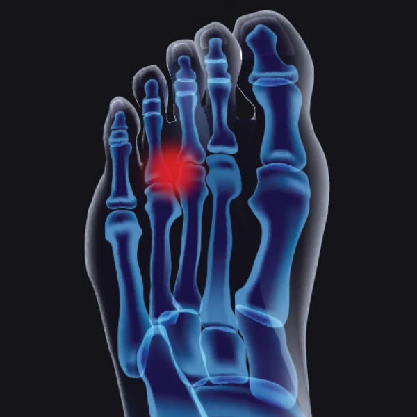 Behind the design: How we can help women with a Morton’s Neuroma